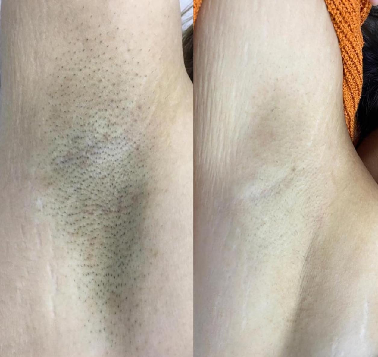 Sidre'de lazer epilasyon sonrası pürüzsüzleşen cildin öncesi ve sonrası görünümü.